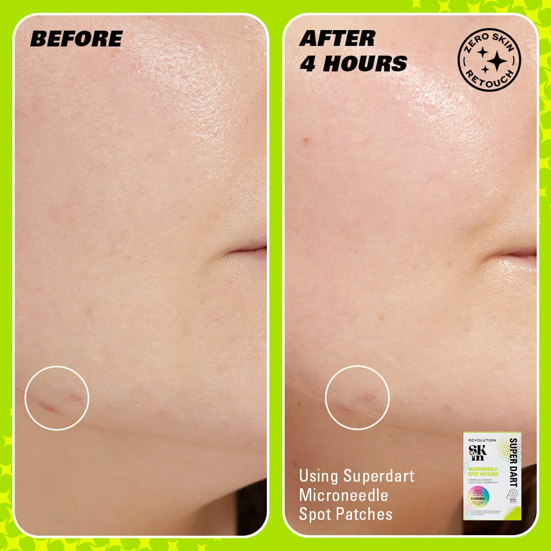 Revolution Skin Super Dart patchs boutons microneedle salicylique